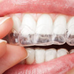 Las 7 mejores aplicaciones de blanqueamiento dental de 2023