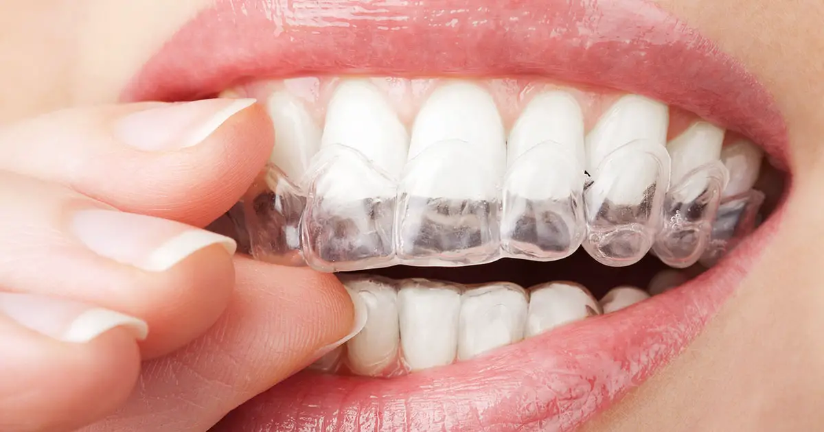 Las 7 mejores aplicaciones de blanqueamiento dental de 2023 11